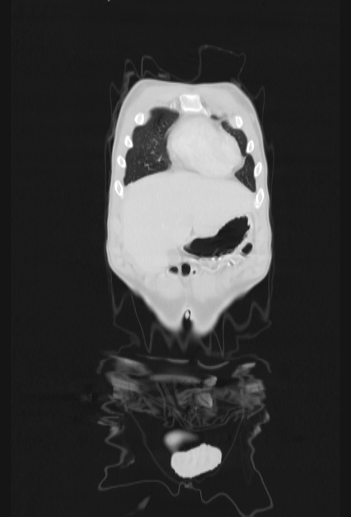 Bronchial carcinoid tumor (Radiopaedia 57187-64090 Coronal lung window 6).jpg