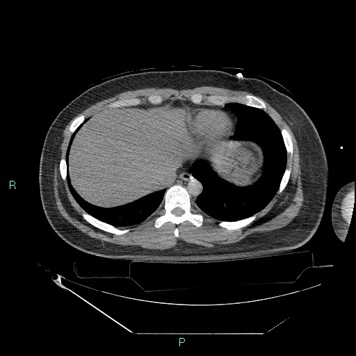 Bronchial carcinoid tumor (Radiopaedia 78272-90870 Axial non-contrast 85).jpg
