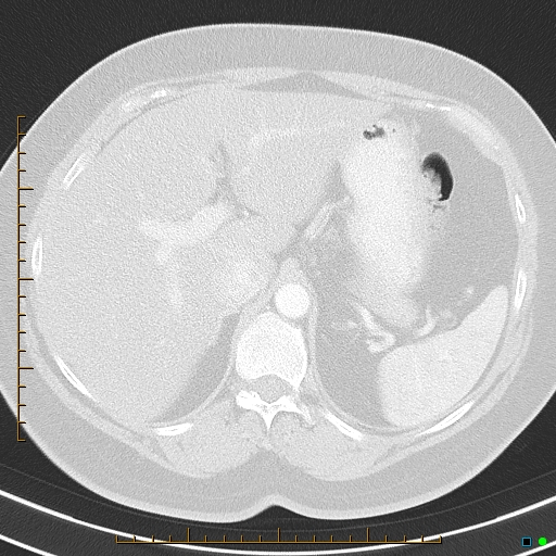 File:Bronchial diverticula (Radiopaedia 79512-92675 Axial lung window 49).jpg