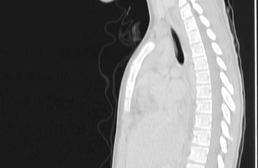 Bronchial mucoepidermoid carcinoma (Radiopaedia 57023-63895 Sagittal lung window 80).jpg