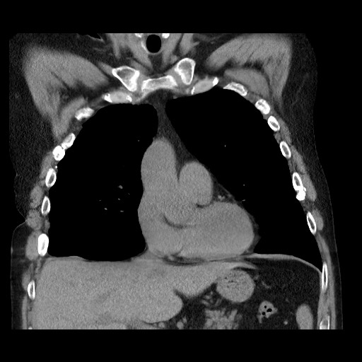 Bronchial stenosis - lung transplant (Radiopaedia 73133-83848 Coronal non-contrast 27).jpg