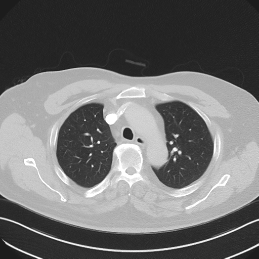 Bronchiectasis (Radiopaedia 39385-41666 Axial lung window 20).png