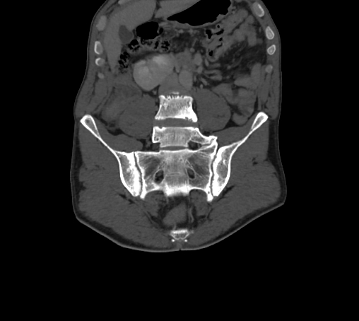 Bronchiectasis in Crohn disease (Radiopaedia 60311-67977 Coronal bone window 28).jpg