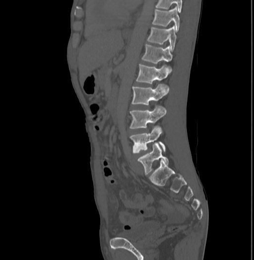 Bronchiectasis in Crohn disease (Radiopaedia 60311-67977 Sagittal bone window 144).jpg