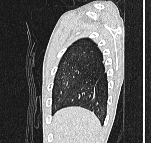 Bronchiolitis obliterans (Radiopaedia 71538-81897 Sagittal lung window 6).jpg