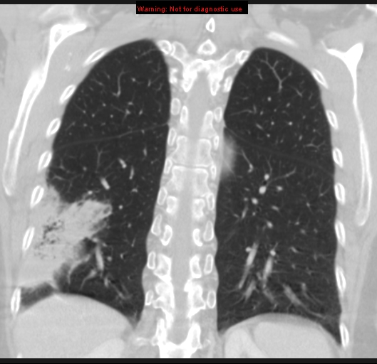 File:Bronchoalveolar carcinoma (BAC) (Radiopaedia 13436-13392 Coronal lung window 44).jpg