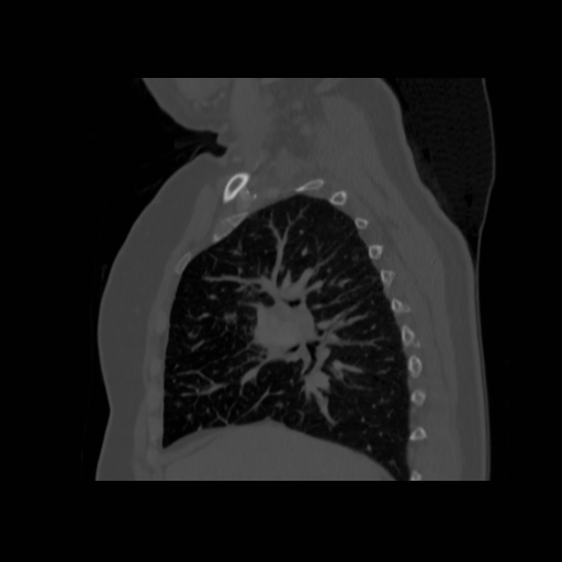 Bronchogenic carcinoma (Radiopaedia 73497-84262 Sagittal bone window 64).jpg