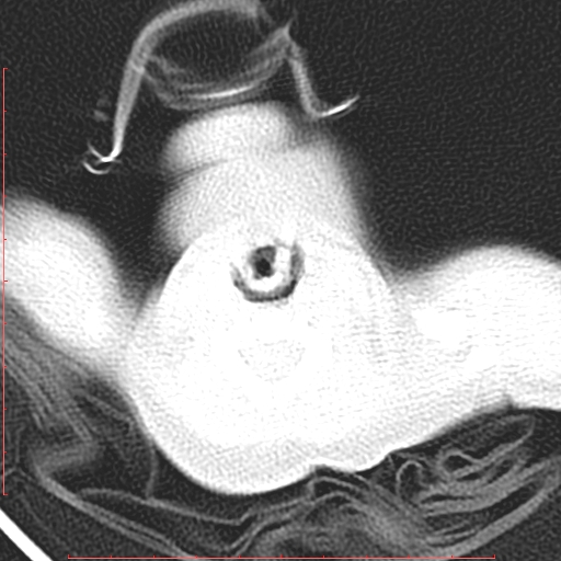 Bronchogenic cyst (Radiopaedia 78599-91409 Axial lung window 1).jpg