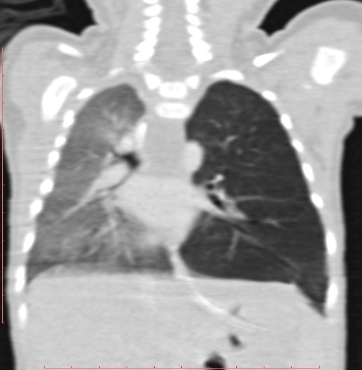 Bronchogenic cyst (Radiopaedia 78599-91409 Coronal lung window 137).jpg