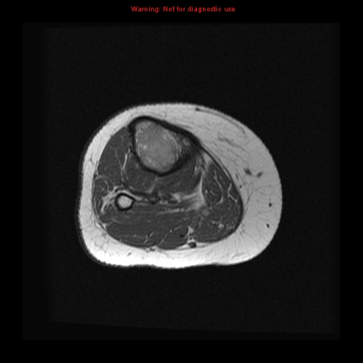 File:Brown tumor (Radiopaedia 12318-12597 Axial T1 16).jpg