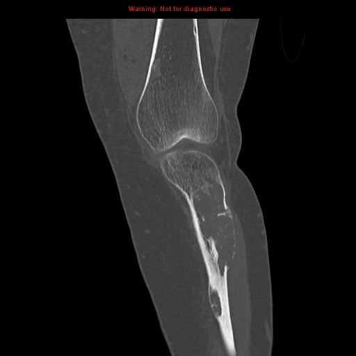 File:Brown tumors (Radiopaedia 9666-10291 Coronal bone window 8).jpg