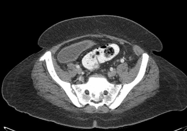 Brown tumors compressing the spinal cord (Radiopaedia 68442-77988 E 97).jpg