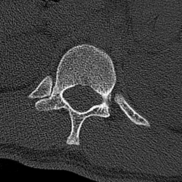 File:Burst fracture (Radiopaedia 53373-59357 Axial bone window 2).jpg