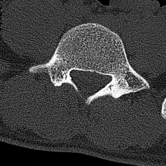 Burst fracture (Radiopaedia 53373-59357 Axial bone window 57).jpg