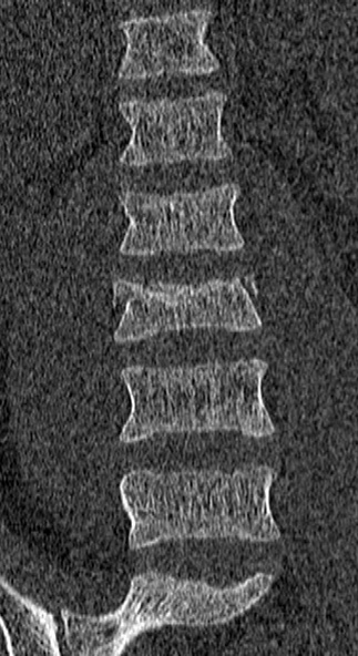 Burst fracture (Radiopaedia 53373-59357 Coronal bone window 22).jpg