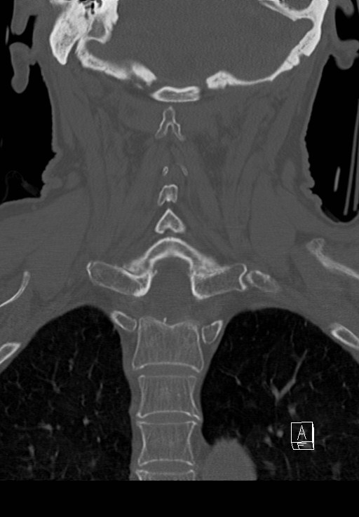 C1 and C2 (peg) fractures (Radiopaedia 36618-38184 Coronal bone window 35).jpg