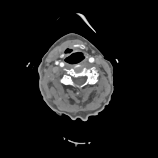 C2 fracture with vertebral artery dissection (Radiopaedia 37378-39200 A 136).png