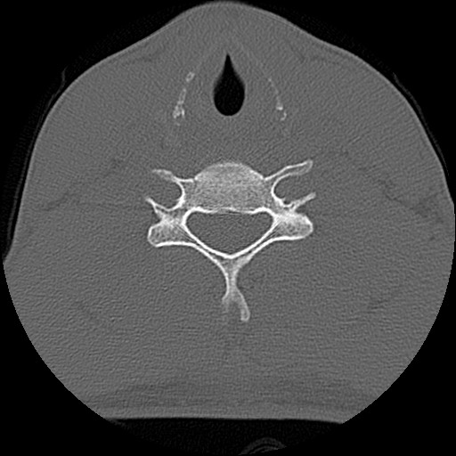 File:C5 facet fracture (Radiopaedia 58374-65499 Axial bone window 61).jpg