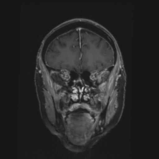 CNS lymphoma with steroid response (Radiopaedia 37980-39921 Coronal T1 C+ 9).png