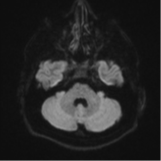 File:CNS vasculitis (Radiopaedia 55715-62263 Axial DWI 36).png