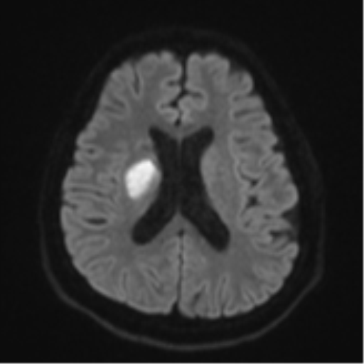 File:CNS vasculitis (Radiopaedia 55715-62263 Axial DWI 47).png