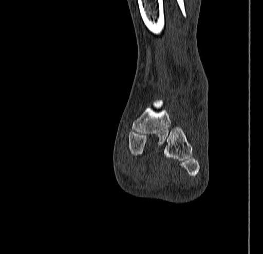 Calcaneal fracture - Sanders type 4 (Radiopaedia 90179-107370 Coronal bone window 52).jpg