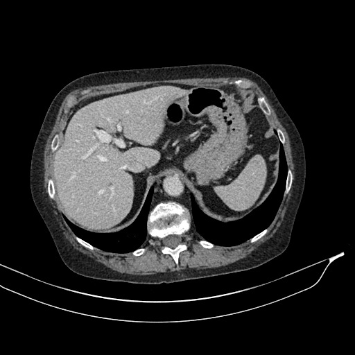 Calcified adrenal glands and Spigelian hernia (Radiopaedia 49741-54988 A 45).jpg