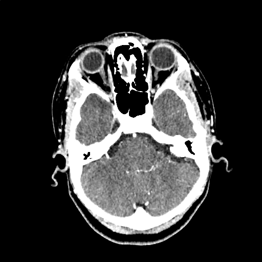 Calcified cerebral hydatid cyst (Radiopaedia 65603-74717 Axial with contrast 13).jpg