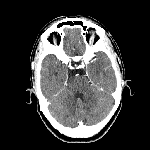 Calcified cerebral hydatid cyst (Radiopaedia 65603-74717 Axial with contrast 20).jpg