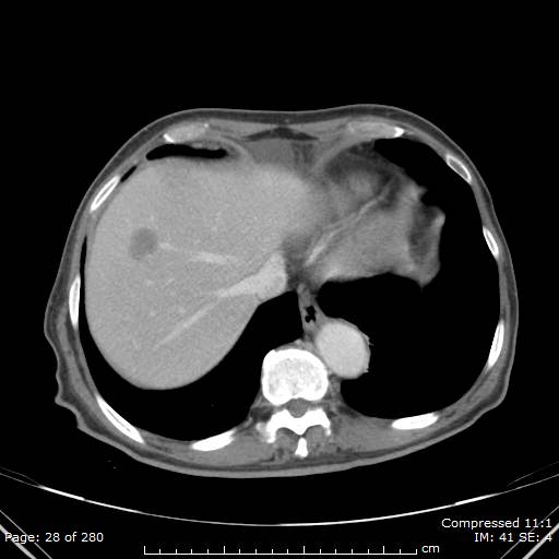 Calcified liver metastases (Radiopaedia 44699-48470 B 10).jpg
