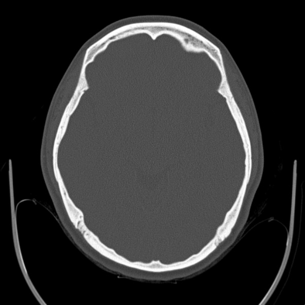 Calvarial osteoma (Radiopaedia 36520-38079 Axial bone window 47).jpg