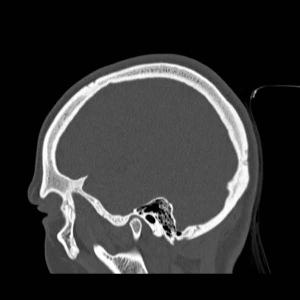 Calvarial osteoma (Radiopaedia 36520-38079 Sagittal bone window 85).jpg