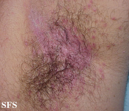 File:Candidiasis (Dermatology Atlas 8).jpg