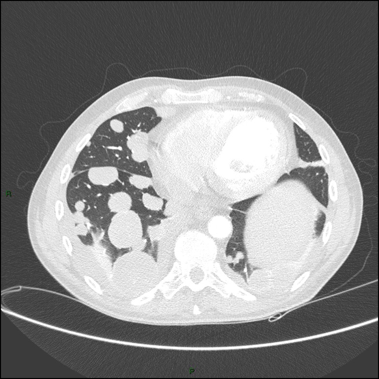 Cannonball metastases (Radiopaedia 82110-96150 Axial lung window 140).jpg