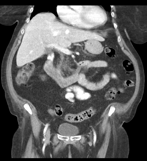Cannonball metastases from endometrial cancer (Radiopaedia 42003-45031 F 31).png