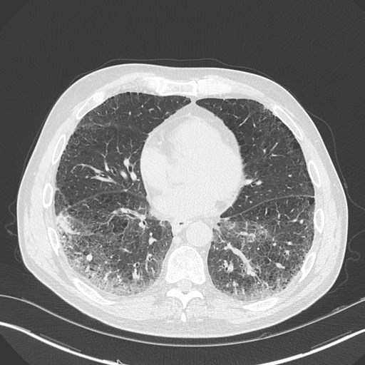 Caplan syndrome (Radiopaedia 56667-63530 Axial lung window 128).jpg