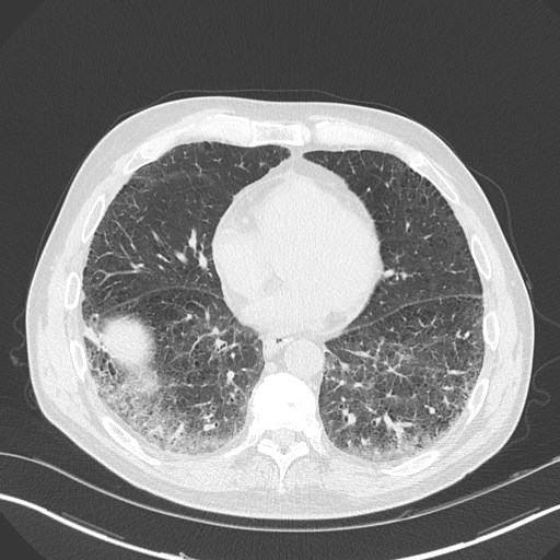 Caplan syndrome (Radiopaedia 56667-63530 Axial lung window 131).jpg