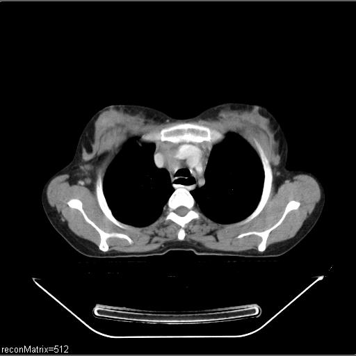 File:Carcinoma of esophagus (Radiopaedia 27356-27550 A 26).jpg