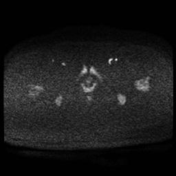 Carcinoma of the cervix (Radiopaedia 89018-105858 Axial DWI 67).jpg