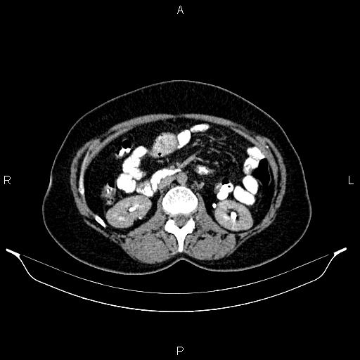 File:Carcinoma of uterine cervix (Radiopaedia 85861-101700 Axial C+ delayed 30).jpg