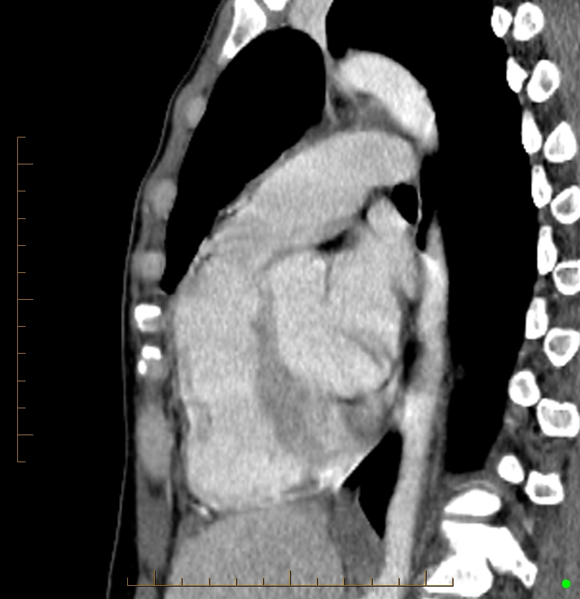 Cardiac paraganglioma (Radiopaedia 76345-88005 C 45).jpg