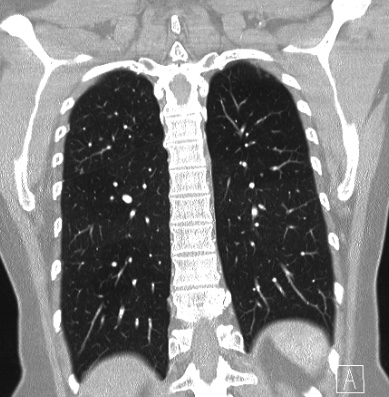 File:Cardiac sarcoidosis (Radiopaedia 74548-85534 Coronal lung window 53).jpg