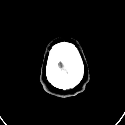 Cardioembolic stroke- ACA and MCA territories (Radiopaedia 58904-66140 Axial non-contrast 165).jpg