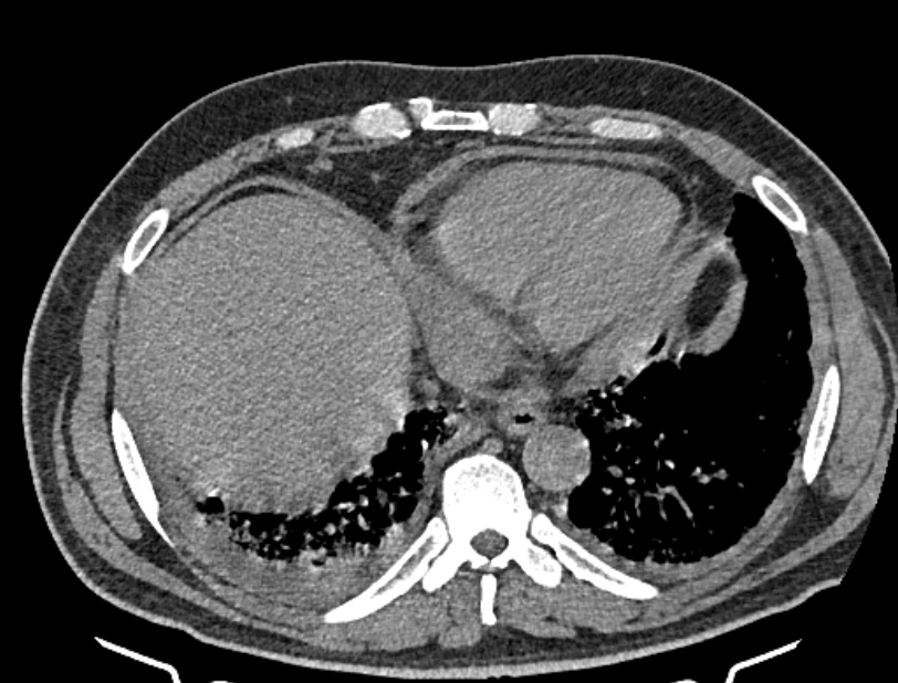Cardiogenic pulmonary edema (Radiopaedia 68180-77678 Axial non-contrast 41).jpg