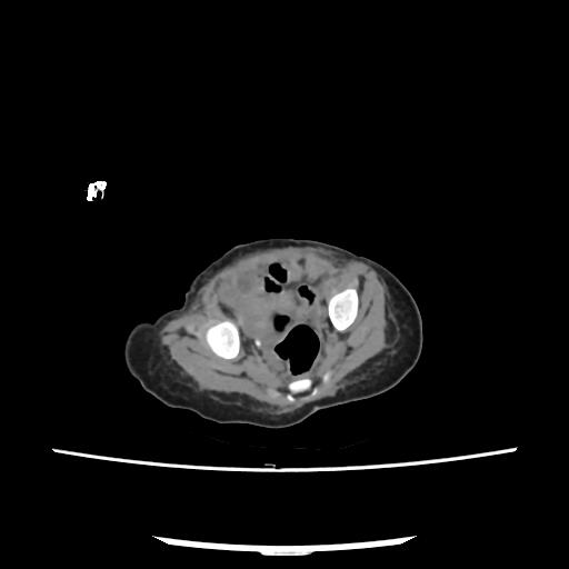 Caroli disease with autosomal recessive polycystic kidney disease (ARPKD) (Radiopaedia 89651-106703 E 210).jpg