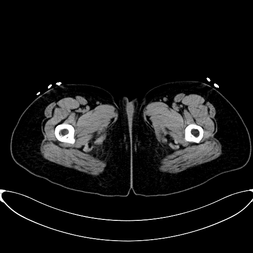 Caroli disease with medullary sponge kidney (Radiopaedia 82622-96804 Axial non-contrast 85).jpg