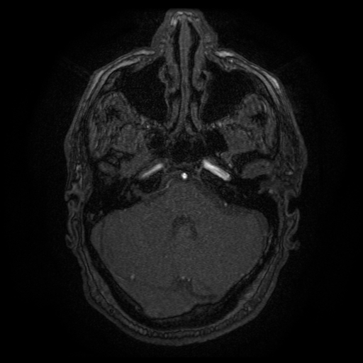 Carotid arterial dissection with acute cerebral infarction (Radiopaedia 26636-26784 MRA 134).jpg