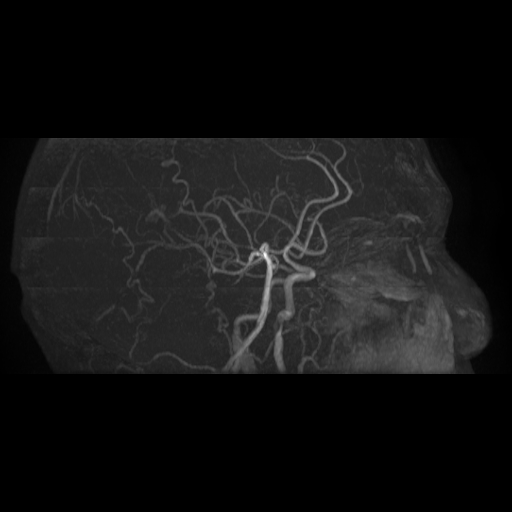 File:Carotid arterial dissection with acute cerebral infarction (Radiopaedia 26636-26784 MRA 18).jpg