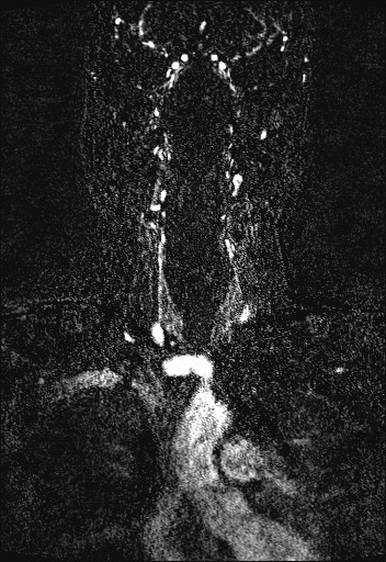 Carotid artery dissection (Radiopaedia 28441-28689 Coronal MRA 24).jpg