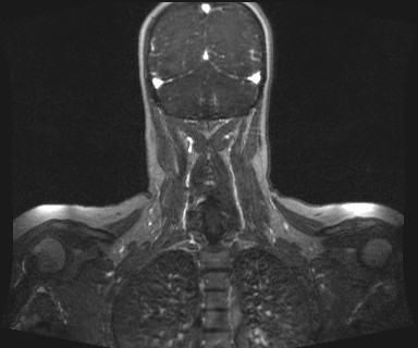 Carotid body tumor (Radiopaedia 12777-12912 MRA 61).jpg